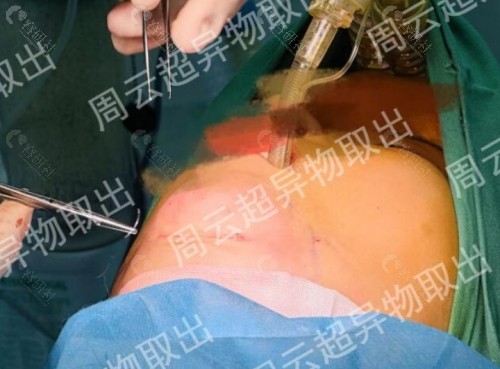 周云超做异物取出收费价格