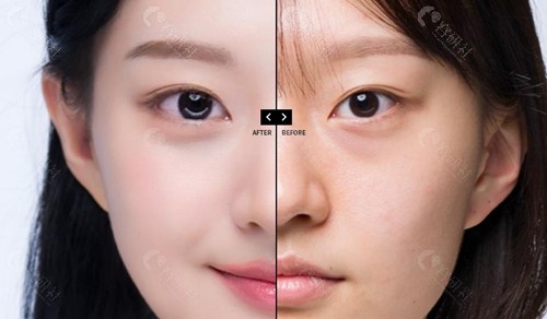 韩国眼底脂肪重排手术哪位医生好？