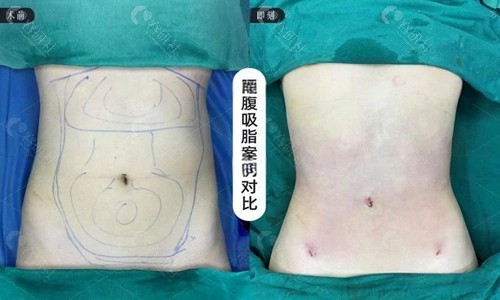 吸脂样图
