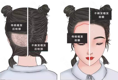 不剃发植发技术优势介绍