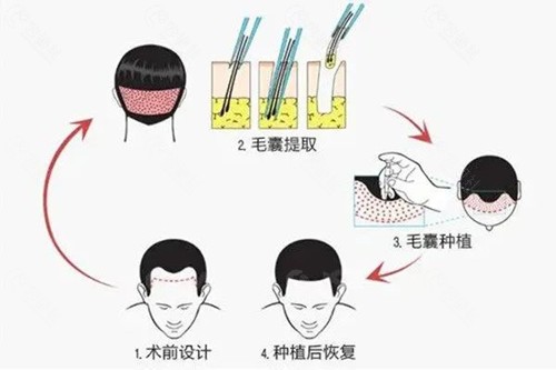 韩国布莱克The Black植发医院怎么样