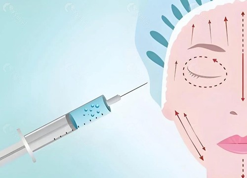 面部紧致针打完多久见成效？