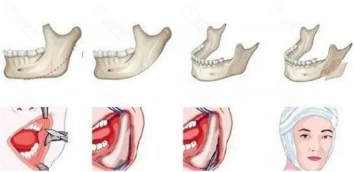 下颌角截骨手术怎么做的？