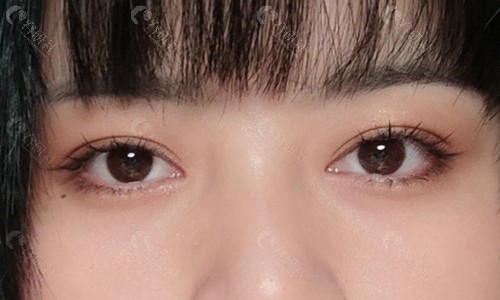平行型双眼皮