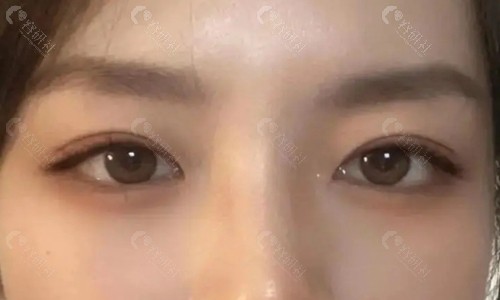 开扇型双眼皮