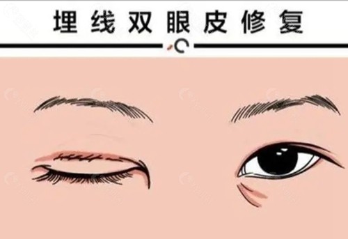 西安双眼皮修复好的医生名单