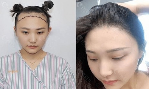 广州植发参考图