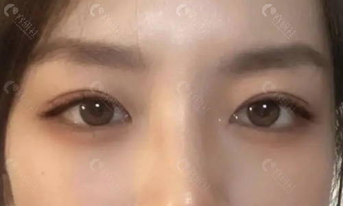 双眼皮术后参考图片