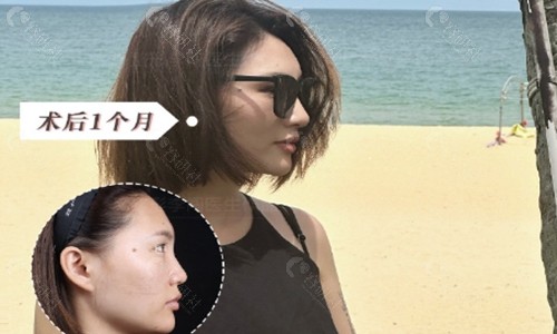 北京玻尿酸隆鼻多少钱