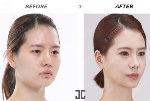 韩国JAYJUN皮肤科术后真实评价