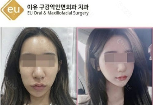 金钟润做双鄂手术前后对比图