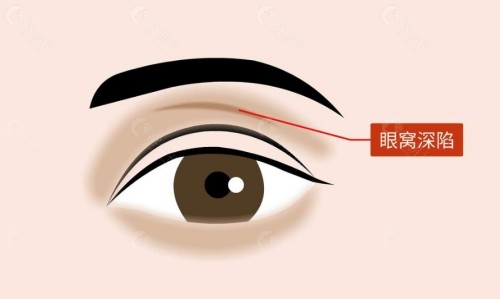 韩国眼窝凹陷填充怎么做？