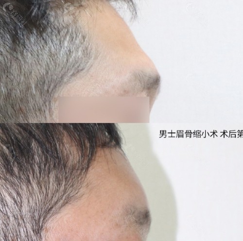 韩国高兰得做眉骨缩小手术真人实例