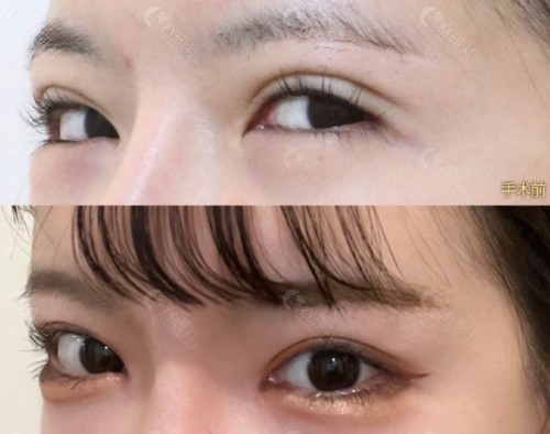 韩国高兰得做眼修复手术真人实例