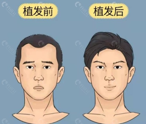 郑州曙光植发医院前后对比图