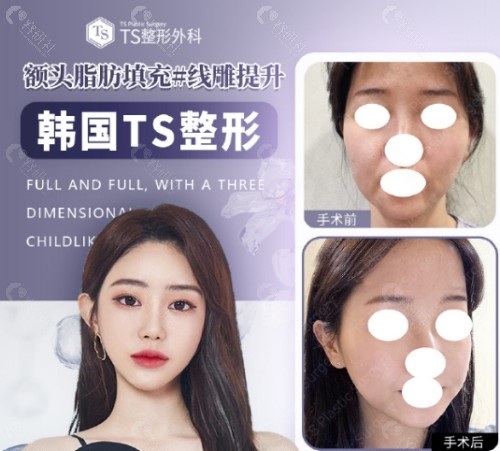 韩国TS整形医院脂肪填充前后对比图