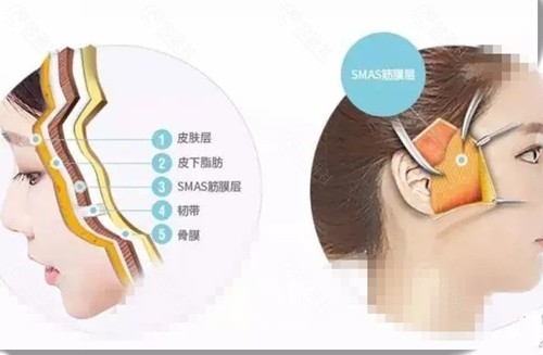 smas提卡术是拉皮手术吗