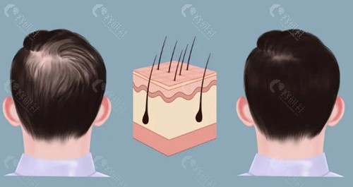 乌鲁木齐华美植发医生技术好不好？