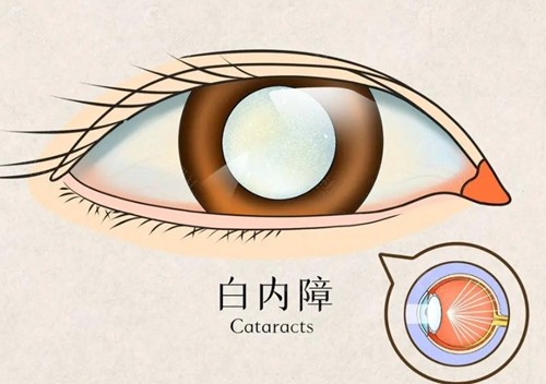 2024济南正规眼科医院白内障手术费用