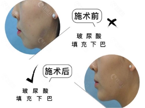 韩国DIAV帝雅皮肤科玻尿酸填充下巴前后对比图