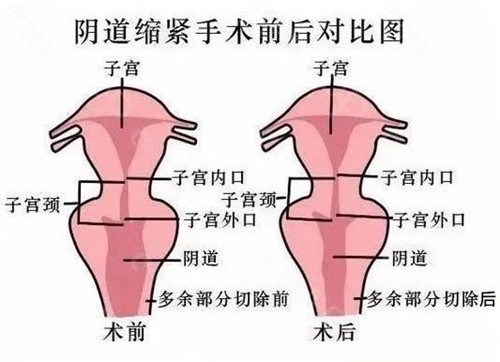 女性私密整形手术适用情况及改善方法盘点