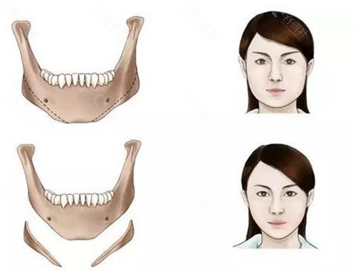 籍建华医生下颌角磨骨靠谱吗