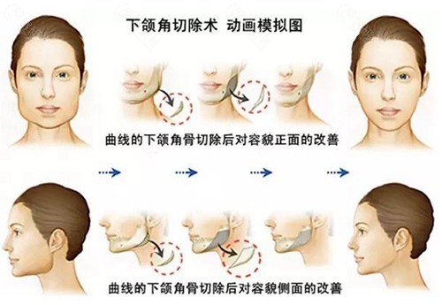 石家庄下颌角整形手术流程