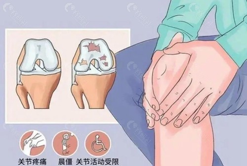 半月板手术类型及优缺点对比