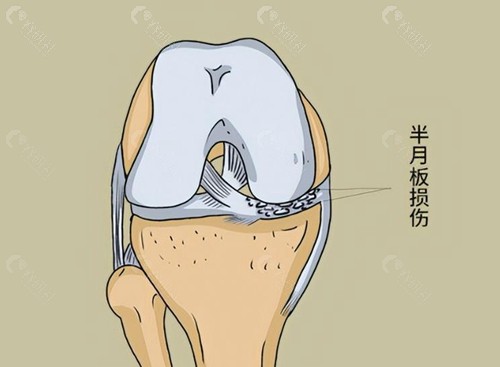 半月板手术可以报销吗？