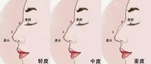 驼峰鼻畸形程度怎么区分？