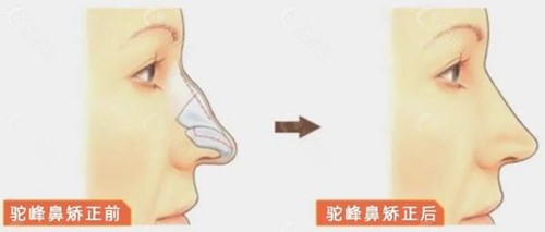 驼峰鼻矫正手术流程一览