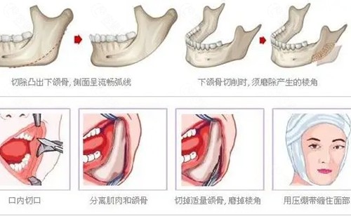 济南下颌角整形哪家医院好