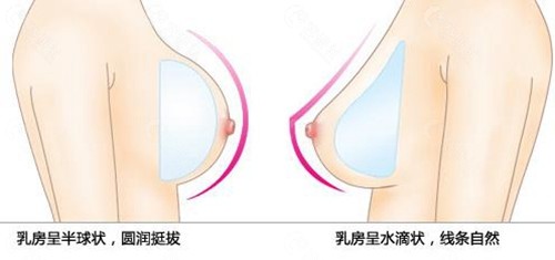 水滴和圆形假体乳房整形对比图