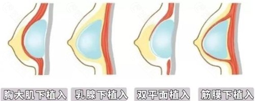 乳房整形植入层次对比图