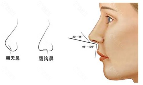 朝天鼻改善有哪些方法？