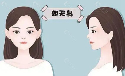 朝天鼻是怎么产生的