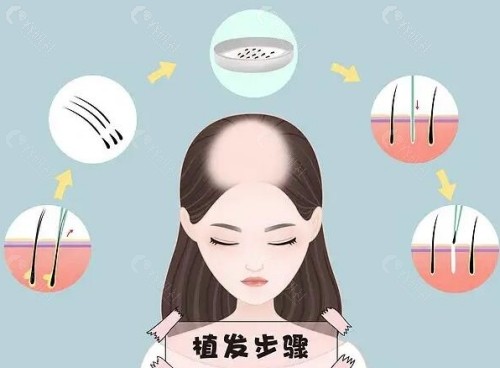 2025国内各地区鬓角植发收费价格表