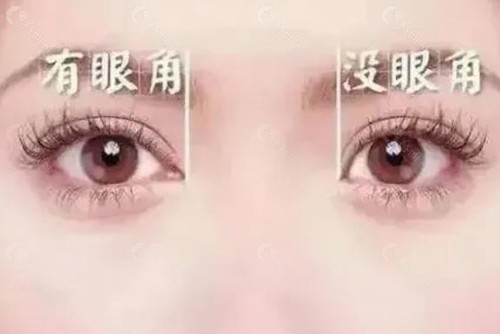 2025开眼角双眼皮多少钱？