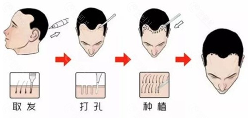 国内植发手术流程一览