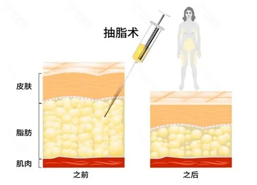 2025成都吸脂医生排名榜