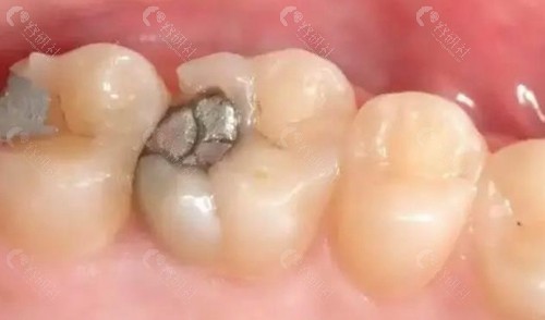 西安口腔医院补牙拔牙价格表