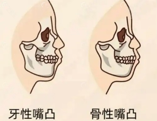 如何判断自己是否有凸嘴？