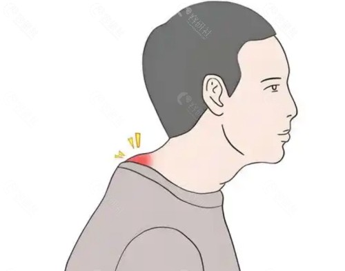 郑志芳做富贵包吸脂怎么样？