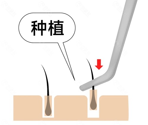 东莞头发种植价格