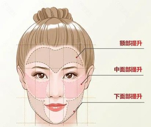 双矢量面部提升四大优势