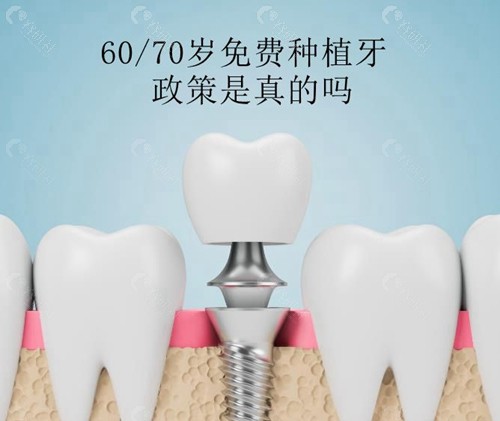 60/70岁免费种植牙政策是真的吗？