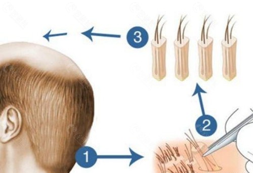 单个毛囊的植发费用