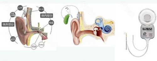 人工耳蜗进入集采了吗？