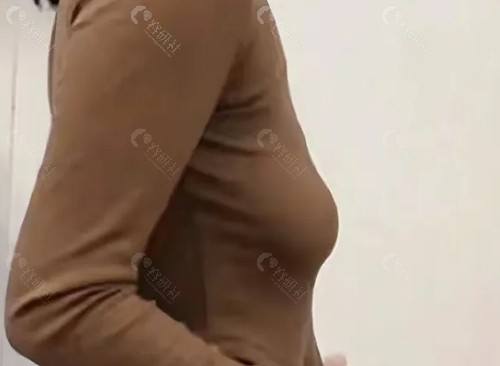 胸部下垂矫正价格