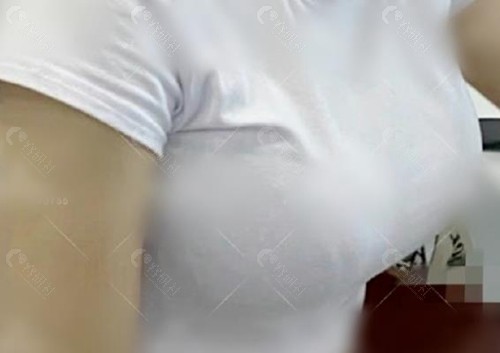 乳房下垂做乳房悬吊双环术后照片